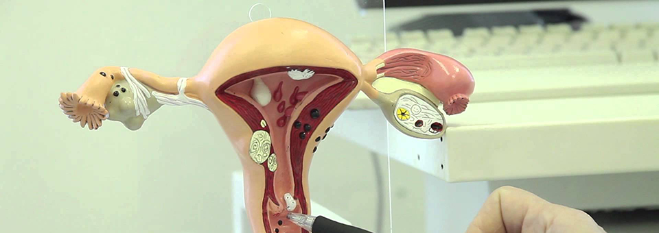 Symptom von Uterusmyom